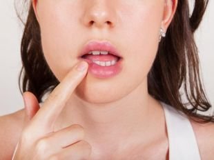 Топ-10 способов лечения герпеса на губах в домашних условиях